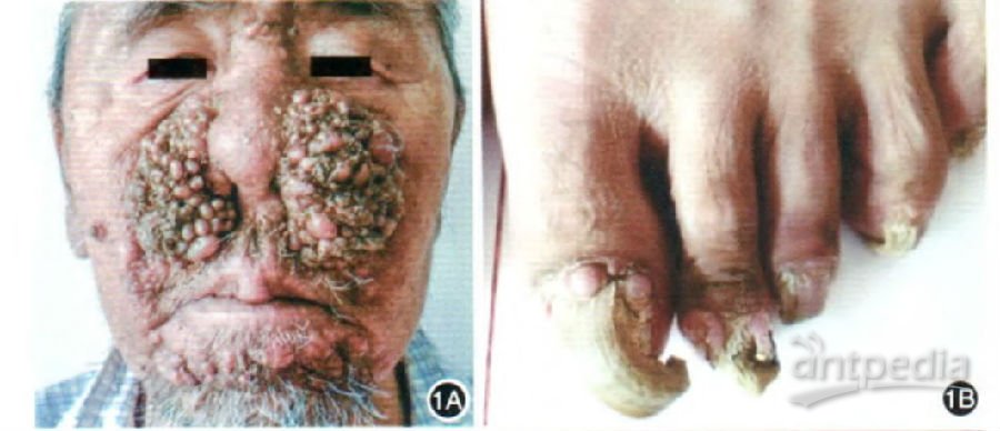 面部纤维瘤图片图片