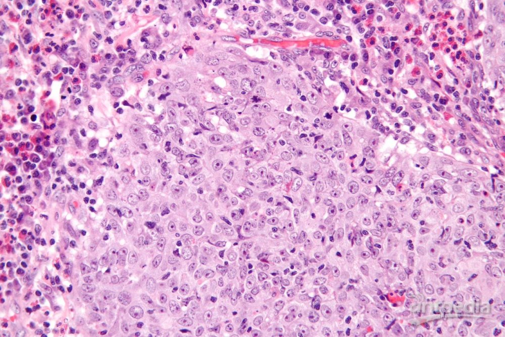 宫颈毛玻璃样细胞癌(图1)