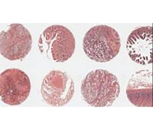 胃癌生存期组织芯片（ZL-STC1601）