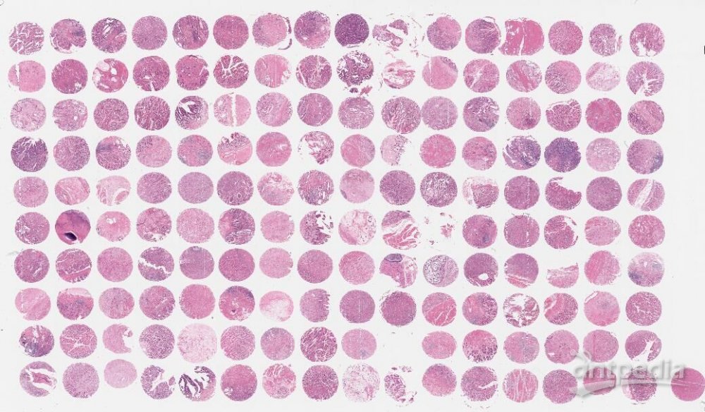 肾嫌色细胞癌组织芯片（KICC1601