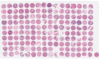 肾嫌色细胞癌组织芯片（KICC1601）